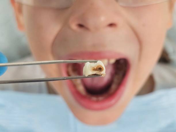 Best Emergency Treatment for Oral Infections in Riverdale, UT